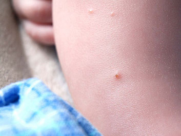 Chickenpox Shingles