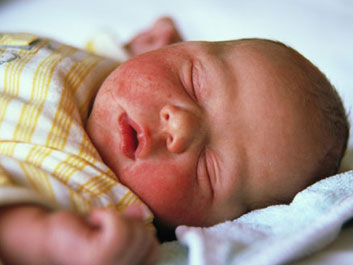 Herpes Shingles Treatment