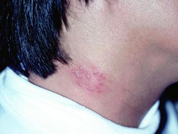 Herpes Zoster Shingles