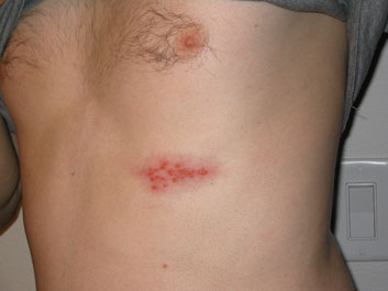 Opioids For Shingles Treatment