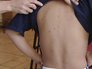 Shingles Treatment And Children