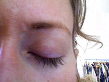 Shingles Treatment For Face