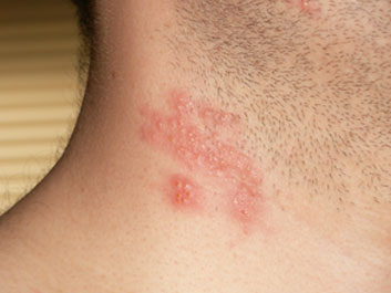 Shortening Shingles With Treatment