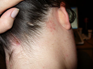 Symptoms Of Shingles