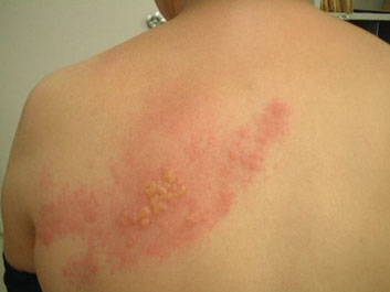 Topical Treatment For Shingles