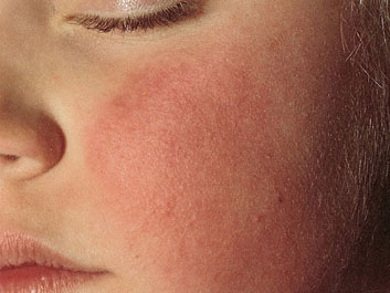 What Does Shingles Look Like